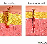 Image result for Skin Laceration Down to the Dermis