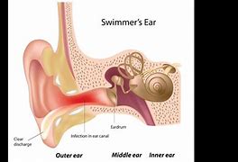 Image result for Otitis