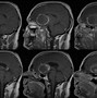 Image result for Aneurysm in MRI