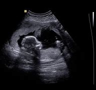 Image result for Ultrasound of Baby Boy