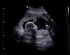 Image result for Baby Girl or Baby Boy Ultrasounds