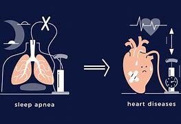 Image result for Diabetes and Osa