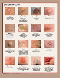 Image result for Skin Rash Identification Chart