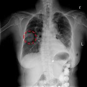 Image result for Chest X-Ray Lungs