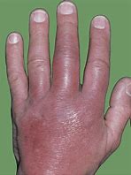 Image result for Wrist Infection