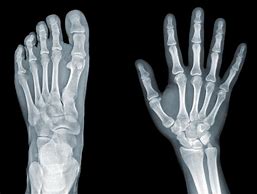 Image result for Bone Spur On Finger