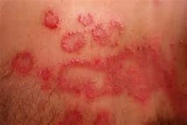 Image result for Candida Rash