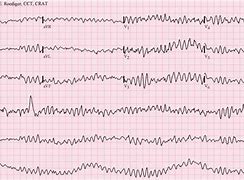 Image result for Ventricular Fibrillation Symptom