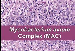 Image result for Mycobacterium Avium Infection