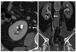 Image result for Teflon Ureter Radiology