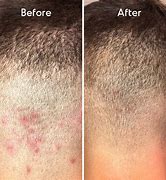 Image result for Bacterial Folliculitis Scalp