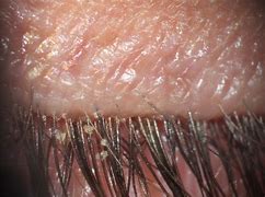 Image result for Mites On Face