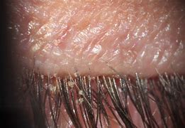 Image result for Face Mites Treatment