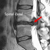 Image result for Lumbar Spine Herniation