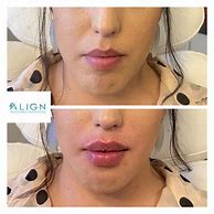 Image result for Versa Lip Filler