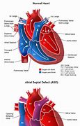 Image result for Atrial Septal Defect Blood Flow