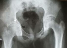 Image result for Hip Joint Space Narrowing