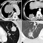 Image result for Lung Cancer On CT