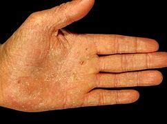 Image result for Baby Eczema Hands