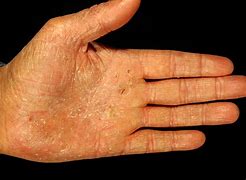 Image result for Eczema On Hands