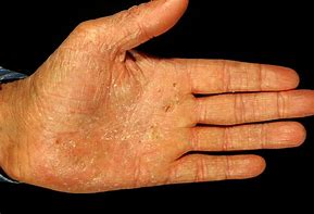 Image result for Eczema Rash On Hands