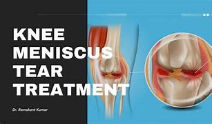 Image result for Right Knee Meniscus