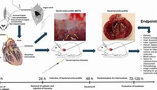 Image result for Acute Endocarditis