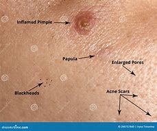 Image result for Papule Pimple