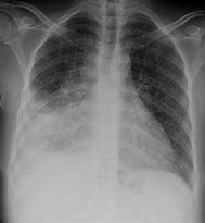 Image result for Chest X-ray of TB