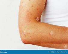 Image result for Allergic Reaction with Pustules