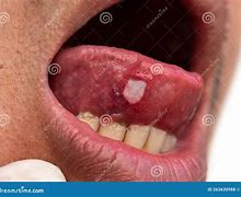 Image result for Open Sore On Tongue