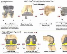 Image result for Left Knee Arthroplasty