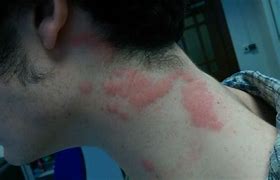 Image result for Big Bed Bug Bites