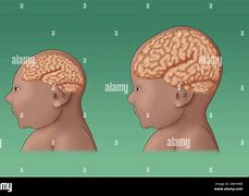 Image result for Cephalic Birth Defects