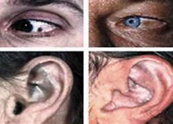 Image result for Alkaptonuria Ear