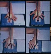 Image result for PA Finger X-ray