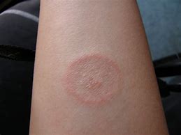 Image result for Circular Rash On Skin