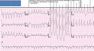 Image result for Polymorphic Wide Complex Tachycardia