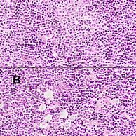 Image result for CLL Richter Transformation Histology