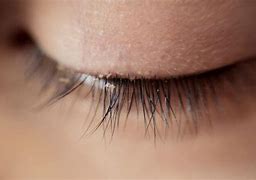 Image result for Eyelash Mites Symptoms