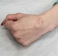 Image result for Ganglion Cyst in Capitate