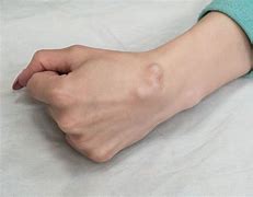 Image result for Cyst On Wrist