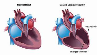 Image result for Dilated Cardiomyopathy EKG