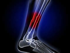 Image result for A Broken Bone