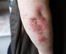 Image result for Clobetasol and Skin Atrophy