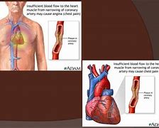 Image result for Angina Pectoris Anatomical Position