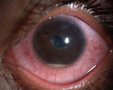 Image result for Uveitis Eye Disease