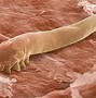 Image result for Eyelash Mites Symptoms