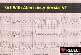 Image result for SVT vs Rapid AFib