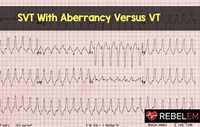 Image result for SVT vs VT ECG